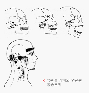 악관절 장애와 연관된 통증부위