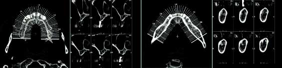 임플란트시술을 위한 CT영상의 예