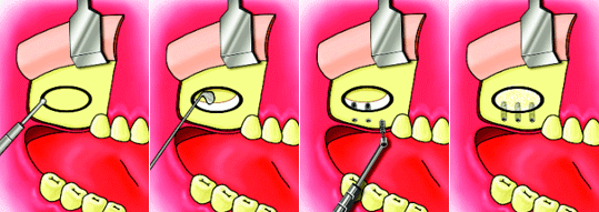 악동 골 거상술을 이용한 골 이식술과 임플란트 식립 도해