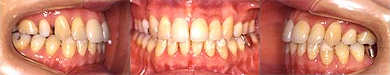 골격성 부정 교합 환자의 치료 후 입안사진