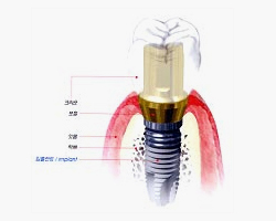 임플란트 사진